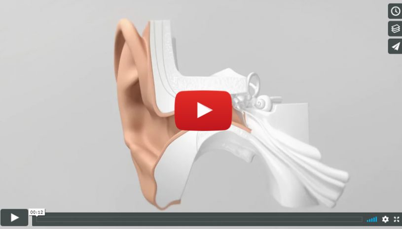Découvrez comment positionner efficacement les aides auditives Lyric 3 de Phonak