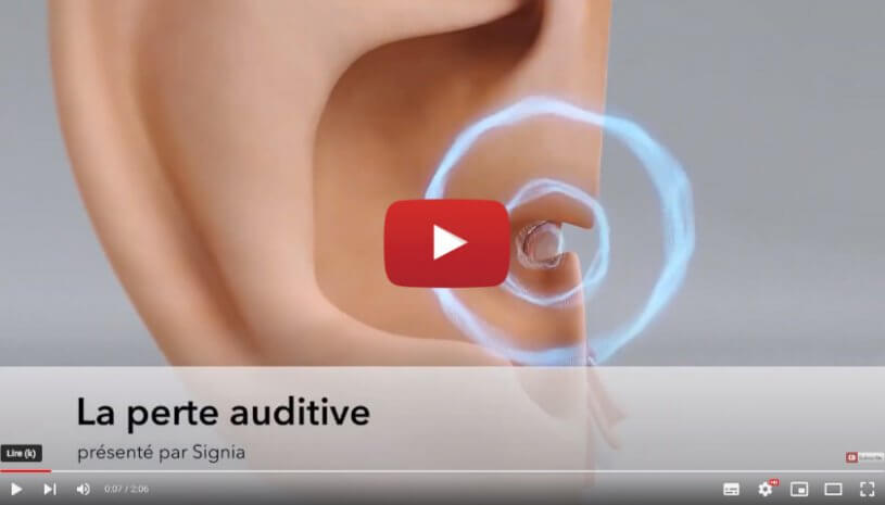 Vidéo : Comprendre la perte auditive | Aides auditives Signia - Audition Conseil